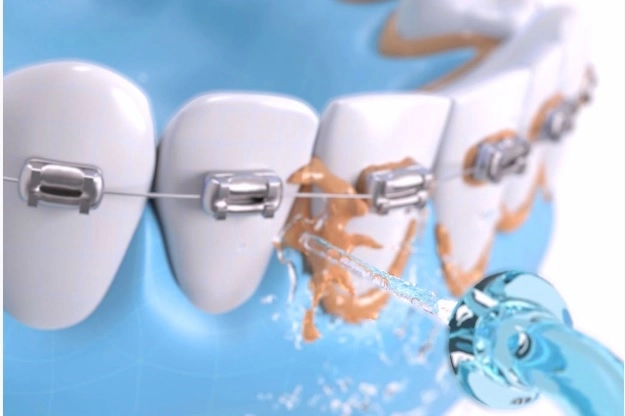 Máy tăm nước cầm tay Xiaomi Soocas W3, vệ sinh răng miệng (01 đầu phun đi kèm)